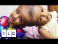 Can These Conjoined Twin Sisters Be Separated Safely? | Body Bizarre