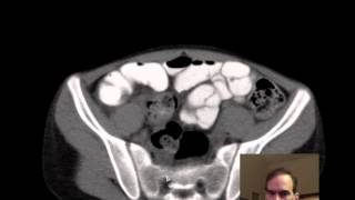 Celebrity Colon Cancer & CT Anatomy 14yo DISCUSSION by Radiologist Profile