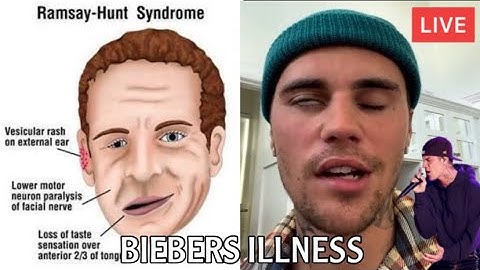 JUSTIN BIEBER Suffers Facial Paralysis | Ramsey Hunt Syndrome