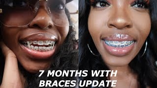 I HAVE BRACES! 7 month braces journey + pictures and video progress (open bite, gaps, elastics, etc)