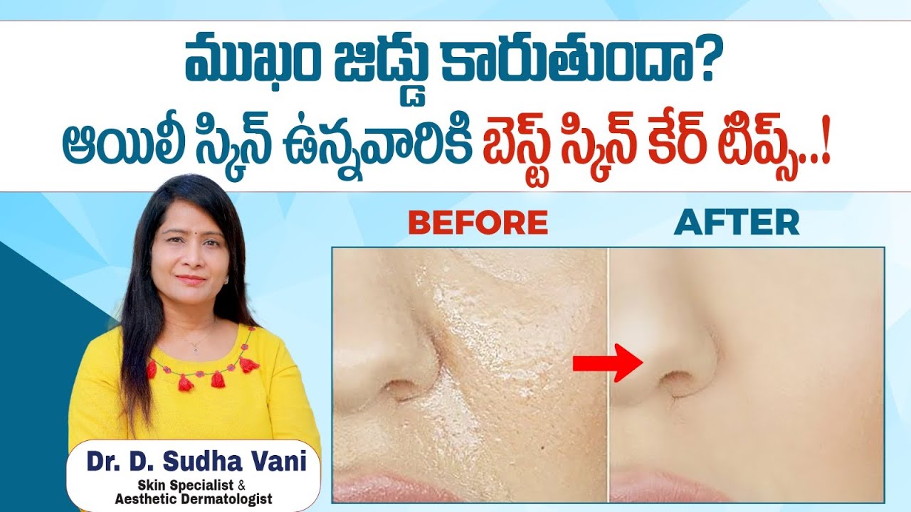 ముఖం జిడ్డు కారుతుందా How to Get Rid of Oily Skin? Oily Skin Care Tips Telugu Srih Skin