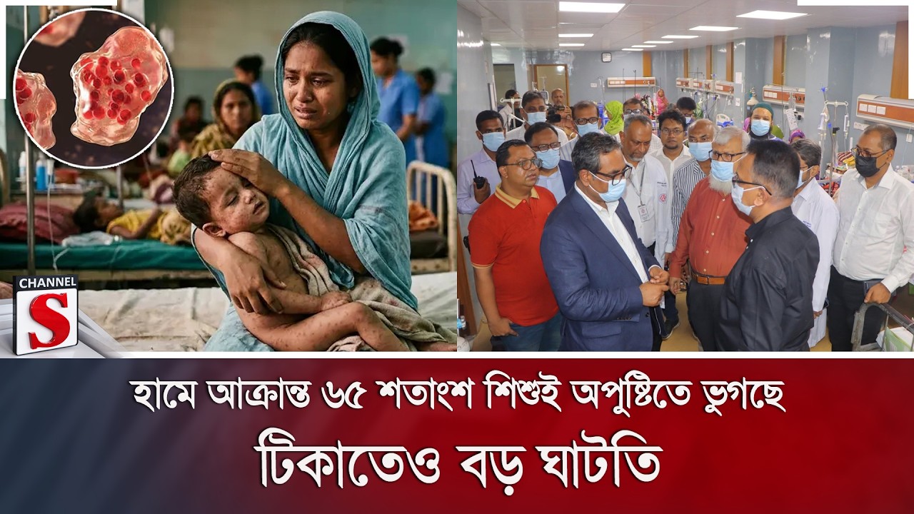 হামে আক্রান্ত ৬৫ শতাংশ শিশুই অপুষ্টিতে ভুগছে; টিকাতেও বড় ঘাটতি | Measles | Channel S News