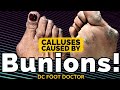 Calluses Caused By Bunions