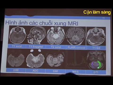 Video: U Nang Não ở Trẻ Sơ Sinh