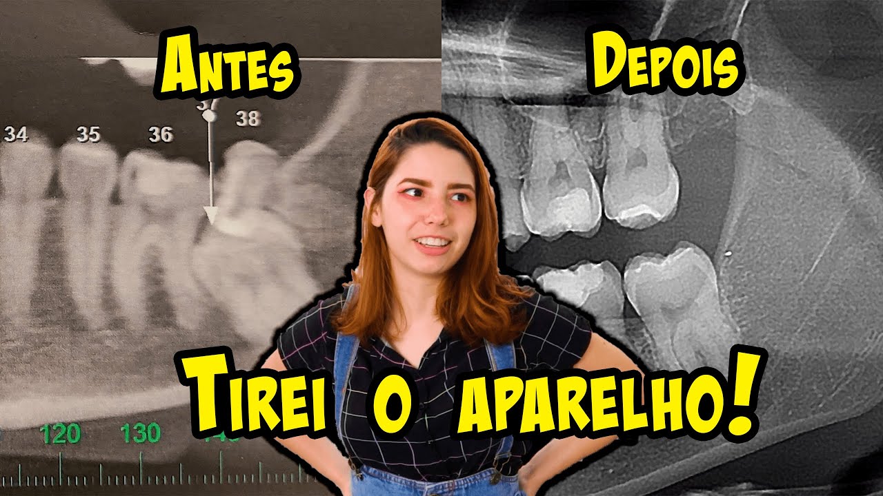 Cosplays e aparelhos: Será que funciona? │Obsidiana