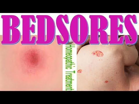 bedsores-best-homeopathic-medicine-|-pressure-ulcers-homeopathy-treatment,-case-&-symptoms-english