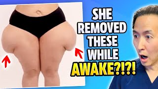Plastic Surgeon Reacts to Removing Saddlebags While AWAKE! by Doctor Youn 291,892 views 3 months ago 10 minutes, 23 seconds