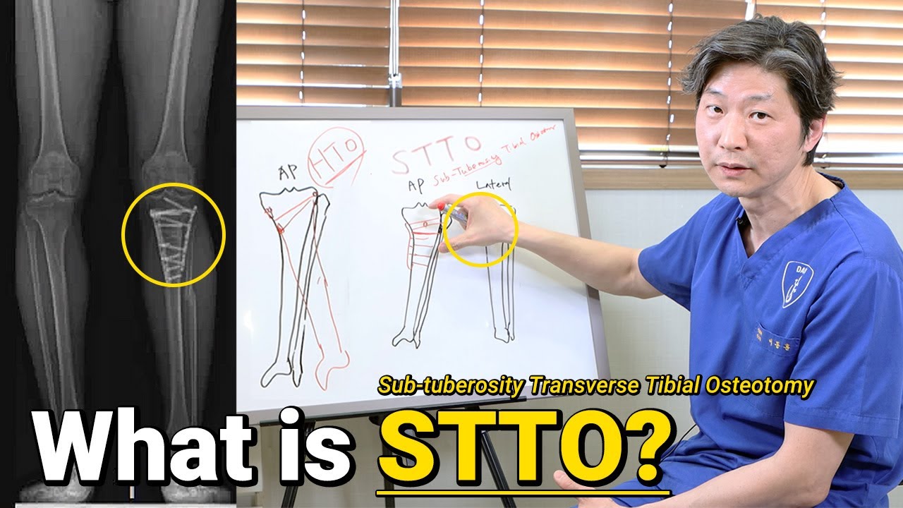 🦴STTO can correct any direction of a deformity🦵