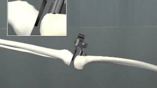 TKR SURGERY Endotec CoCr Size 3 2009