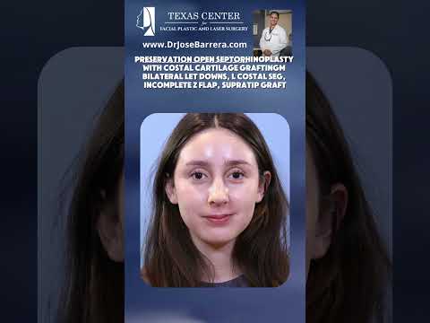 Video thumbnail: Preservation Open Septorhinoplasty featuring Costal Cartilage Grafting, Bilateral Letdowns,