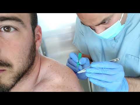 Videó: Sebaceous Cyst: Okai, Diagnózisa és Kezelése