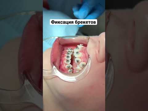 Фиксация брекетов самолигирующих
