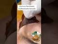 100% Blackheads Whiteheads Removal ✅