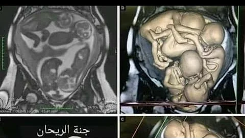 الحمل بتوأم ذكور