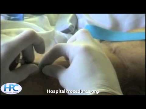 Ultrasound Guided Peripheral IV video