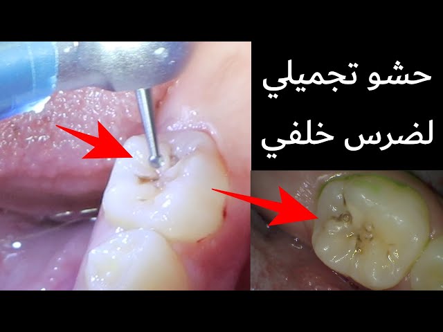 خطوات حشو الأسنان
