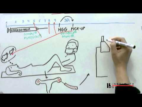 Video: Fecondazione In Vitro