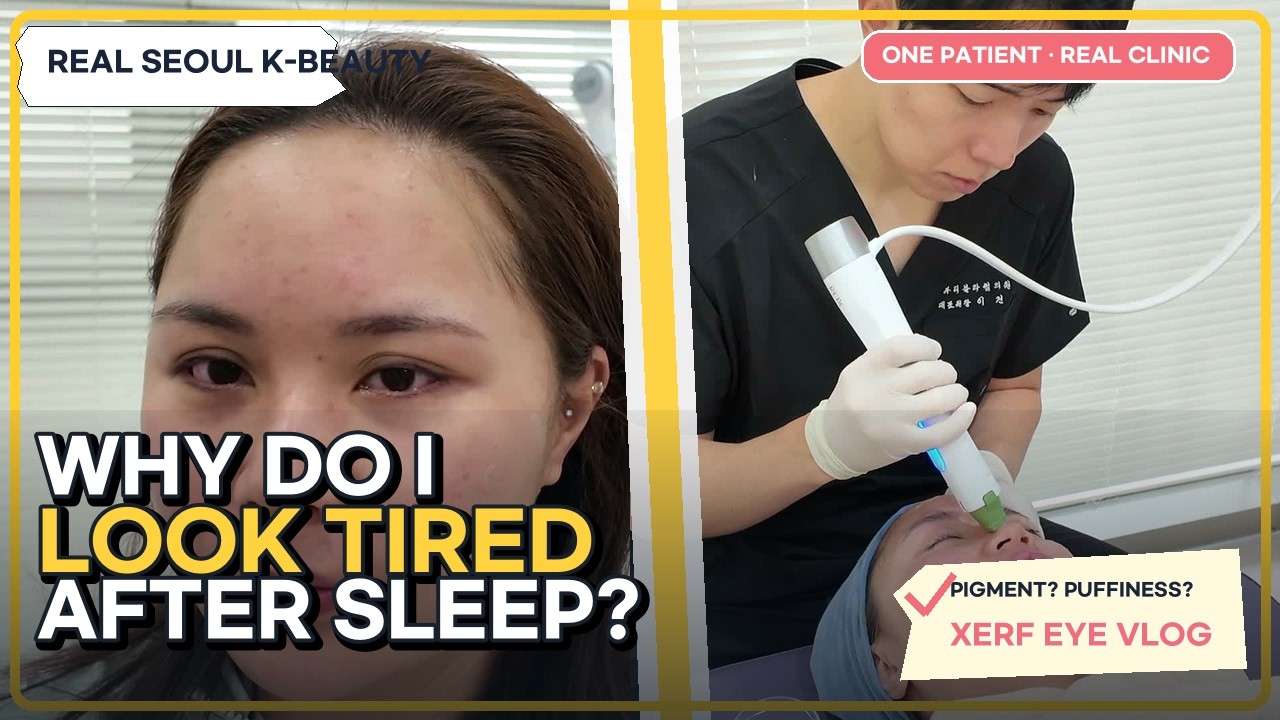 Why Your Eyes Still Look Tired After Sleep | XERF Eye RF in Seoul