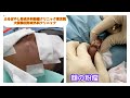 顔の粉瘤　 ブログでも詳しく解説してます。　東京皮膚のできものと粉瘤クリニック　ふるばやし形成外科新宿院　大阪梅田形成外科クリニック