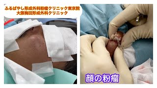 顔の粉瘤　 ブログでも詳しく解説してます。　東京皮膚のできものと粉瘤クリニック　ふるばやし形成外科新宿院　大阪梅田形成外科クリニック
