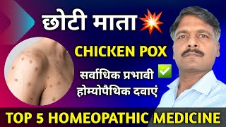 Live Ask Dr Ratnesh Kumar Singh | Chicken Pox Homeopathy Best Treatment | 04/04/24