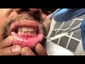 Inside the lip ( inside the mouth) tattoo laser tattoo removal