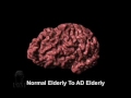 Cortical Atrophy Associated with Alzheimer's Disease