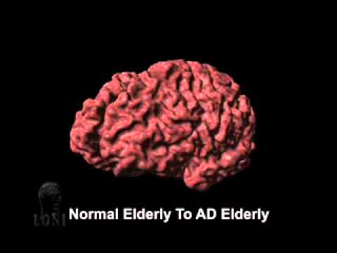 آتروفی قشر مرتبط با بیماری آلزایمر