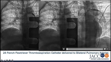 Cath Lab: Percutaneous Thrombectomy - JACC PCP | Sudden Respiratory Distress in Pregnancy