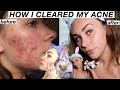 HOW I CLEARED MY SKIN AND ACNE SCARS  *fungal and hormonal cystic acne journey*