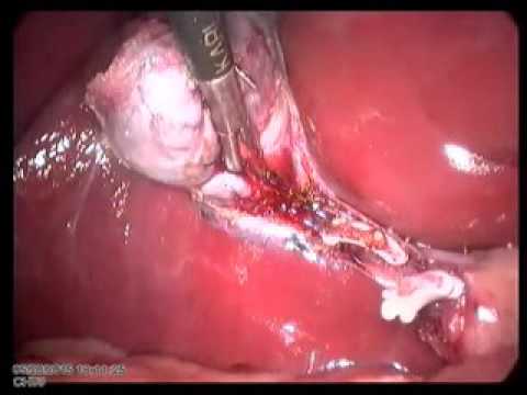 Lap Cholecystectomy 20150520 Unedited In Patient With Previous Upper Abdominal Surgery Mild Adhesion