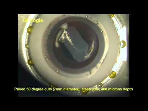 Video: Keratotomie Astigmatică Asistată Cu Laser De Femtosecond: O Recenzie
