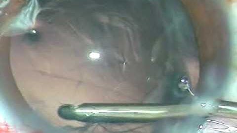 Soft cataract - " Lift-The-Endonucleus" Technique (If Golden Ring forms)