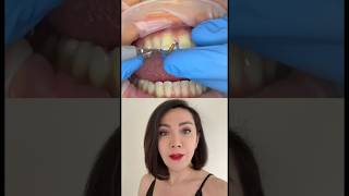 Closing The Gaps In Between Your Front Teeth!