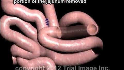 Intussusception Treatment video - Animaton by Cal Shipley, M.D.