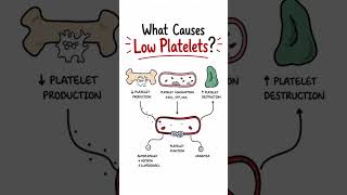 Immunology Insights: What Causes Low Platelets? #thrombocytopenia #platelets #haematology #meded
Low platelets can result from reduced production, increased consumption or destruction, or platelet dysfunction. Learn the key mechanisms behind thrombocytopenia and bleeding disorders.
Watch the full video for the complete explanation 👉 https://www.youtube.com/watch?v=YClJciaGe6s Immunology Insights: What Causes Low Platelets? #thrombocytopenia #platelets #haematology #meded