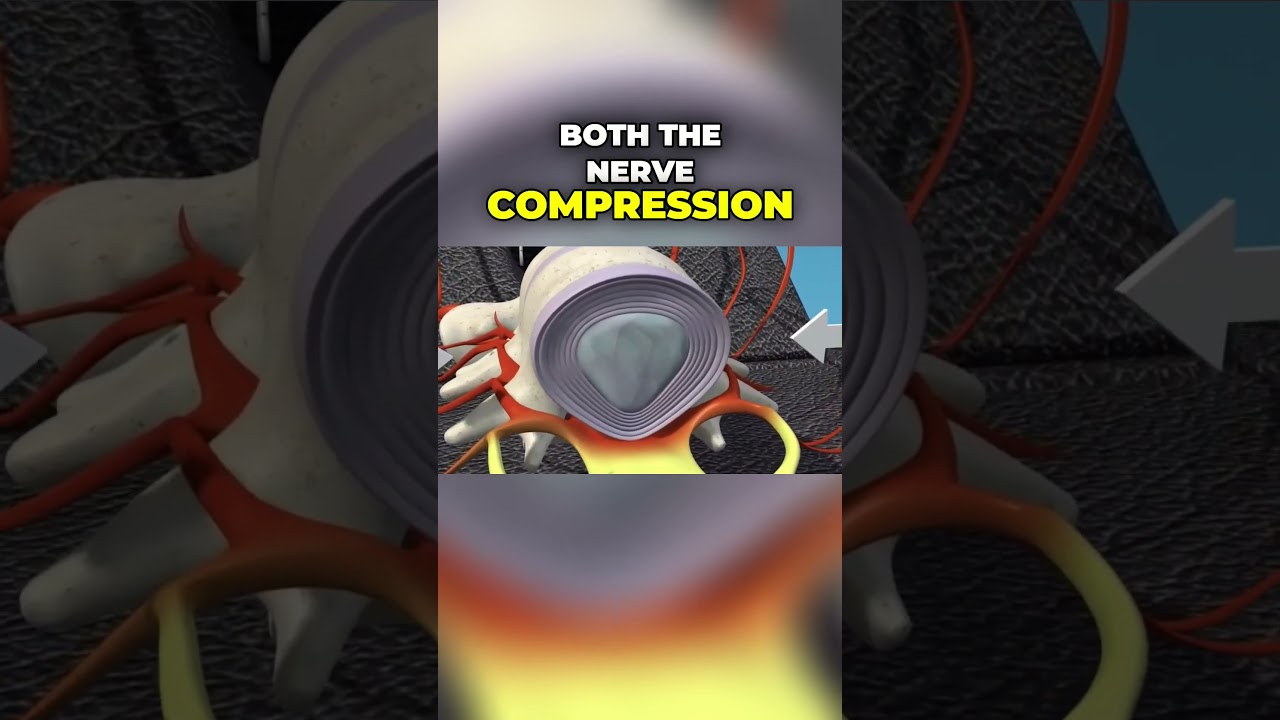 Laser Therapy + Non-Surgical Decompression| Dr. John Zielonka Chiropractor In Ottawa, ON