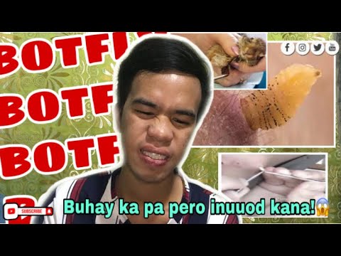 BOTFLY REMOVAL | REACTION VIDEO - YouTube
