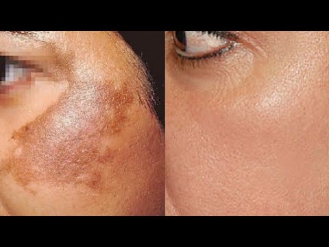 How To Treat Skin Pigmentation, Dark Spots, Acne Scars Easily At Home।