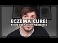 Eczema / Seborrheic Dermatitus CURE! Bicarb and Coconut Oil Routine