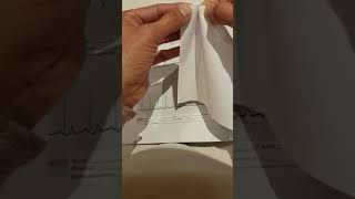 Mapping P Waves In Av Blocks Prt 1