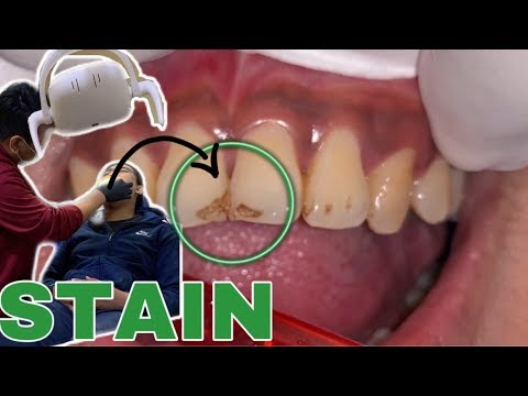 Video: 3 Cara Menghilangkan Noda Teh dari Gigi