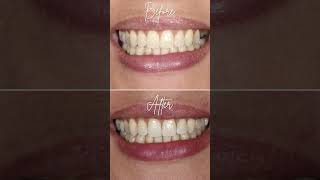 Catia's Implants for Missing Teeth