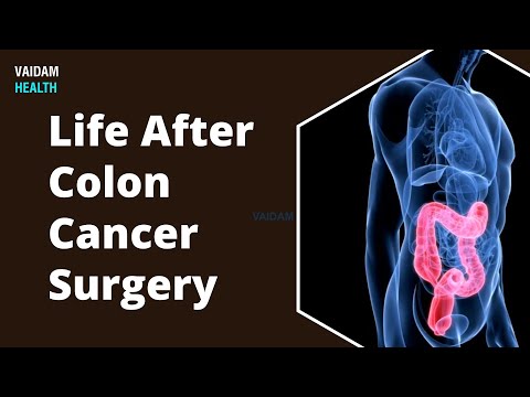 कोलन कैंसर सर्जरी के बाद का जीवन