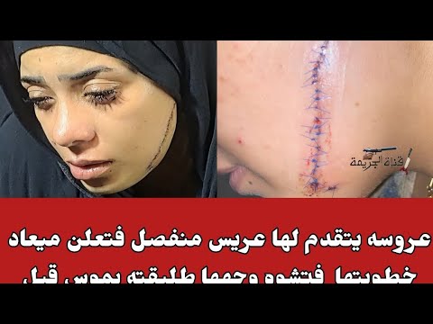 قطعت وشها عروسه وشها باظ بسبب الغيرة موس وأصابتها بوجهها إصابات بالغة استلزم ٤١ غرزة جراحية