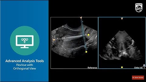 Philips GYN Solution