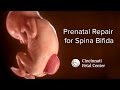 Spina Bifida Medical Animation | Cincinnati Fetal Center