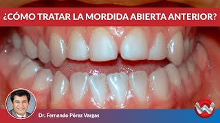 Mordida Abierta Anterior, Cuáles son sus Causas y Tratamiento