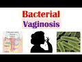 Bacterial Vaginosis (Vaginal Infection): Causes, Risk Factors, Symptoms, Diagnosis, Treatment