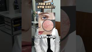 #색소 #색소치료 #실핏줄 #레이저치료 #피부관리 #피부과 #피부과추천 #대전 #둔산동 #daejeon #skin #koreanbeauty